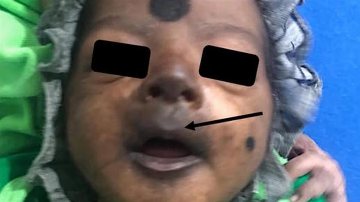 12天新生兒染屈公病「臉部竟發黑」醫示警：恐多重器官衰竭