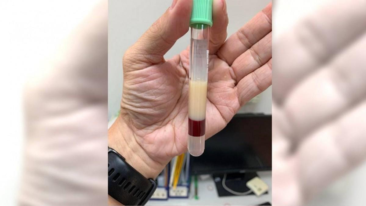 高血脂病患血液「真的一層油」！ 醫曝驚悚畫面網看呆：可以煎魚了