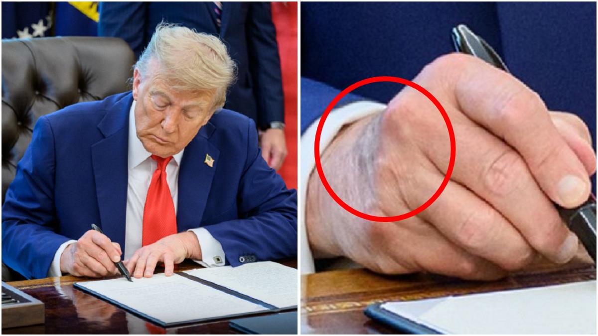 川普健康出狀況？ 手背大面積瘀青 白宮回應了