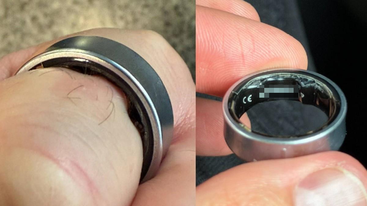 智慧戒指電池鼓脹「拔不下」 網紅被拒登機 急衝醫院拆除