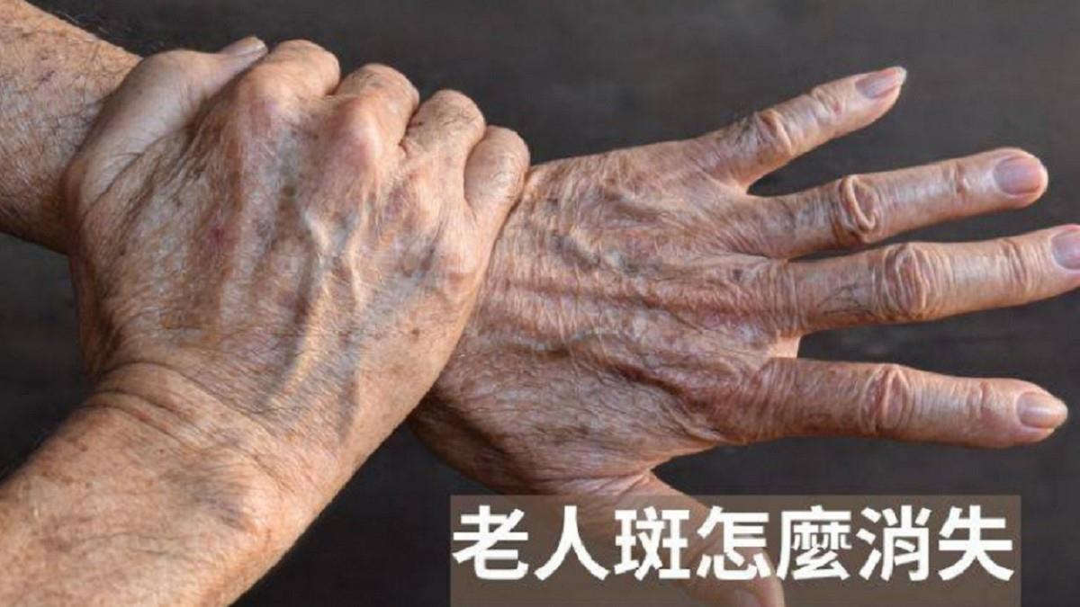 老人斑不只是老化！ 醫曝異常警訊 揭修復關鍵