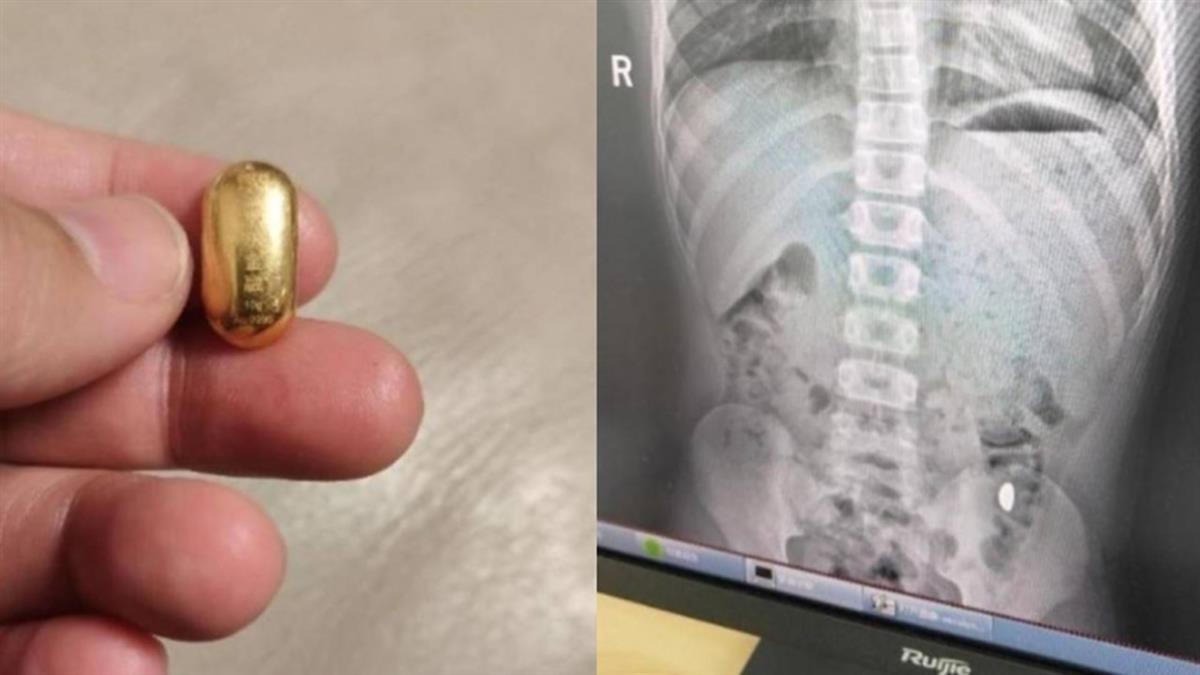 孩誤吞10克金豆！ 媽不准他在外解放：這坨很貴