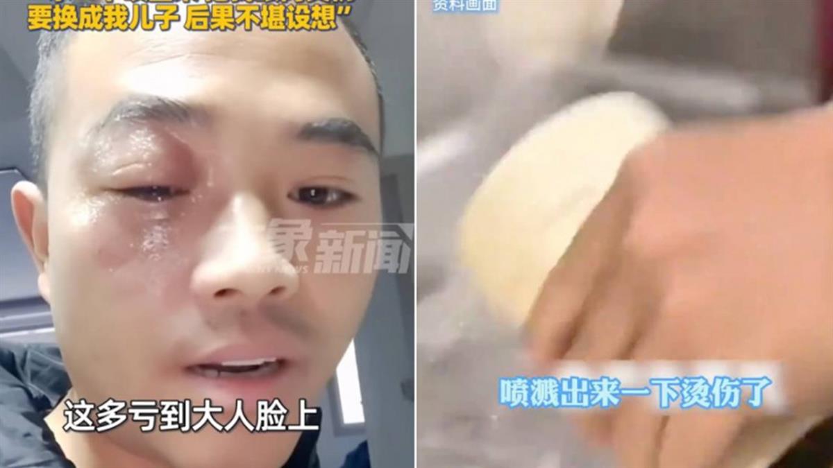 熱開水倒保溫杯！ 「1動作」害熱水噴濺 男灼傷眼腫成麵龜