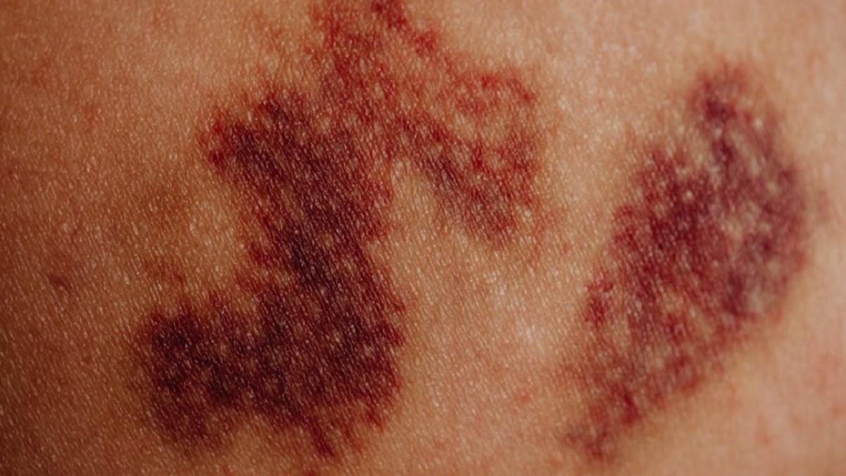 M痘再增7例！社區傳播風險持續 3族群快打疫苗