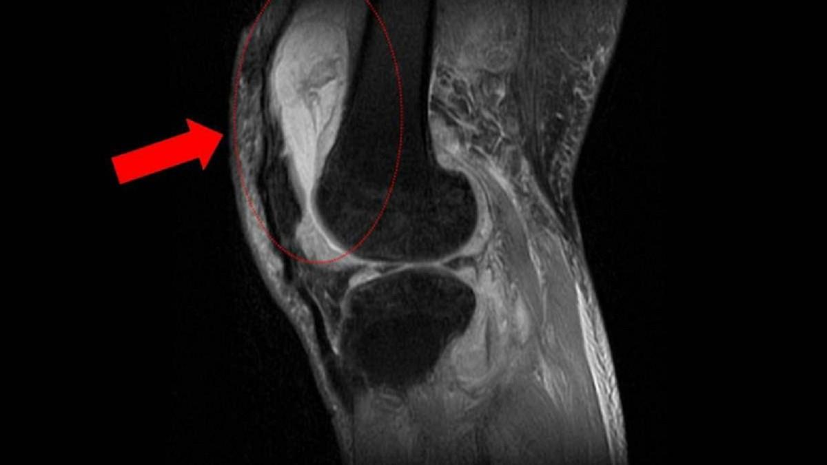 膝蓋腫到彎不了！ 他吃止痛藥更嚴重 就醫驚見「骨化膿 」